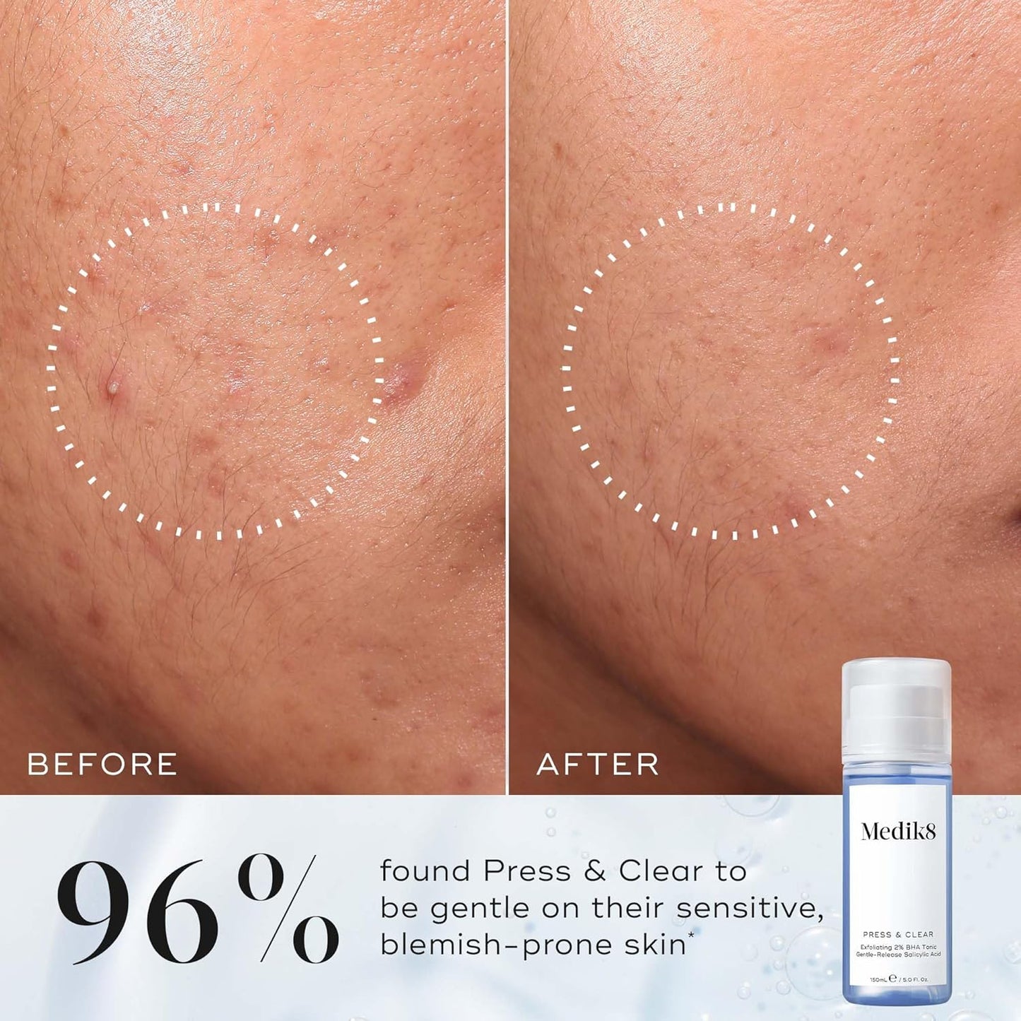 Medik8 Press and Clear 150ml featuring encapsulated salicylic acid tranexamic acid and aloe vera for gentle daily exfoliation and visible post-blemish mark reduction