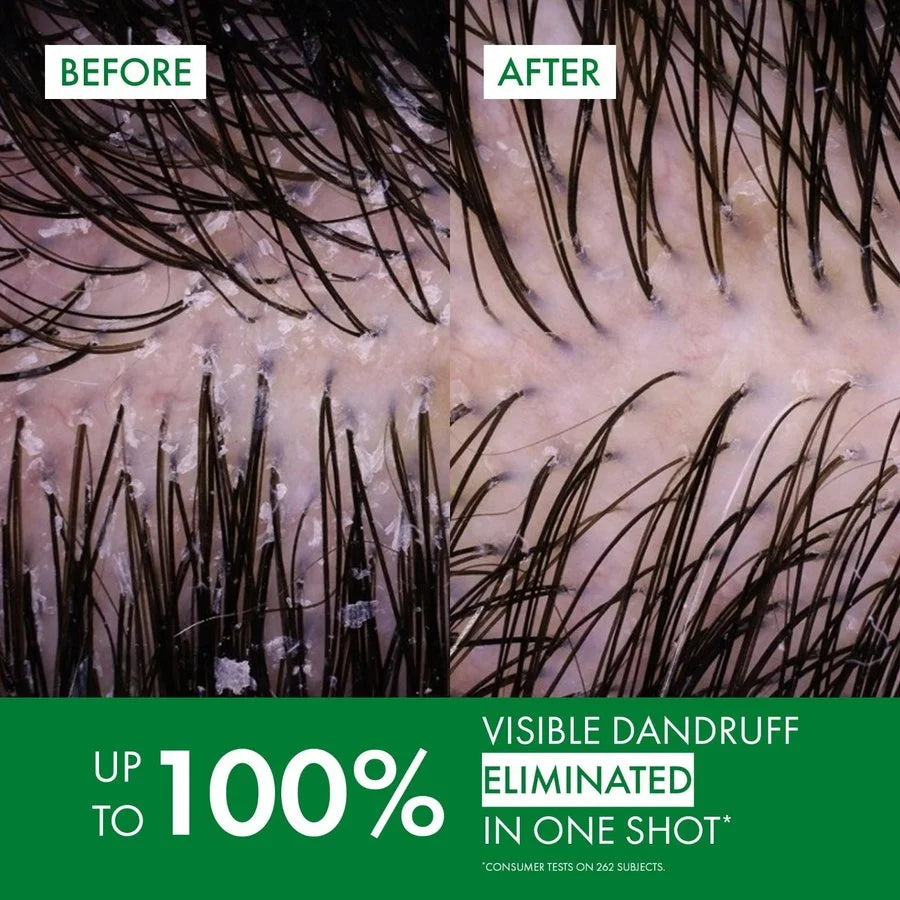 Vichy Dercos Anti-Dandruff Shampoo for normal to oily scalps, helps restore a cleaner, fresher, flake-free appearance